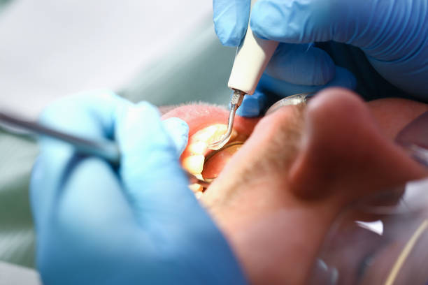 Best Emergency Dental Care for Broken or Chipped Teeth in Mount Jackson, VA