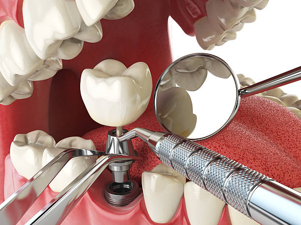 Best Emergency Wisdom Teeth Removal in Mount Jackson, VA